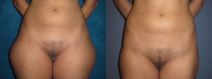 lipo-before-and-after-2