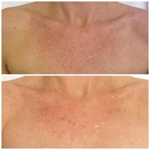 IPL chest before and after