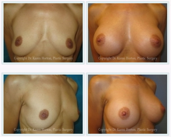 Before and after silicone gel breast augmentation in a "nulliparous" patient (has not yet had children).  Implants were placed above the muscle to preserve muscle function and achieve the most natural results. 