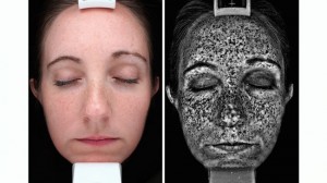 Most sun damage is invisible! A shocking analysis under special light shows deep sun damage that is not yet visible at the surface. IPL can help!