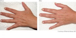 IPL hands before & after