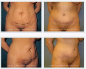Before and after abdominoplasty - visible separation of rectus abdominis muscles and loose, baggy skin are removed and the result is a tighter, more contoured abdomen