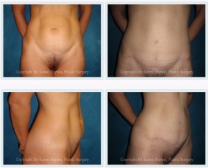 Before and after abdominoplasty - obvious rectus diastasis is corrected from top to bottom, with a low, short scar.  While some might call this a "mini" abdominoplasty, the full job was completed!  