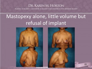 Mastopexy after Extreme Weight Loss HORTON 031315