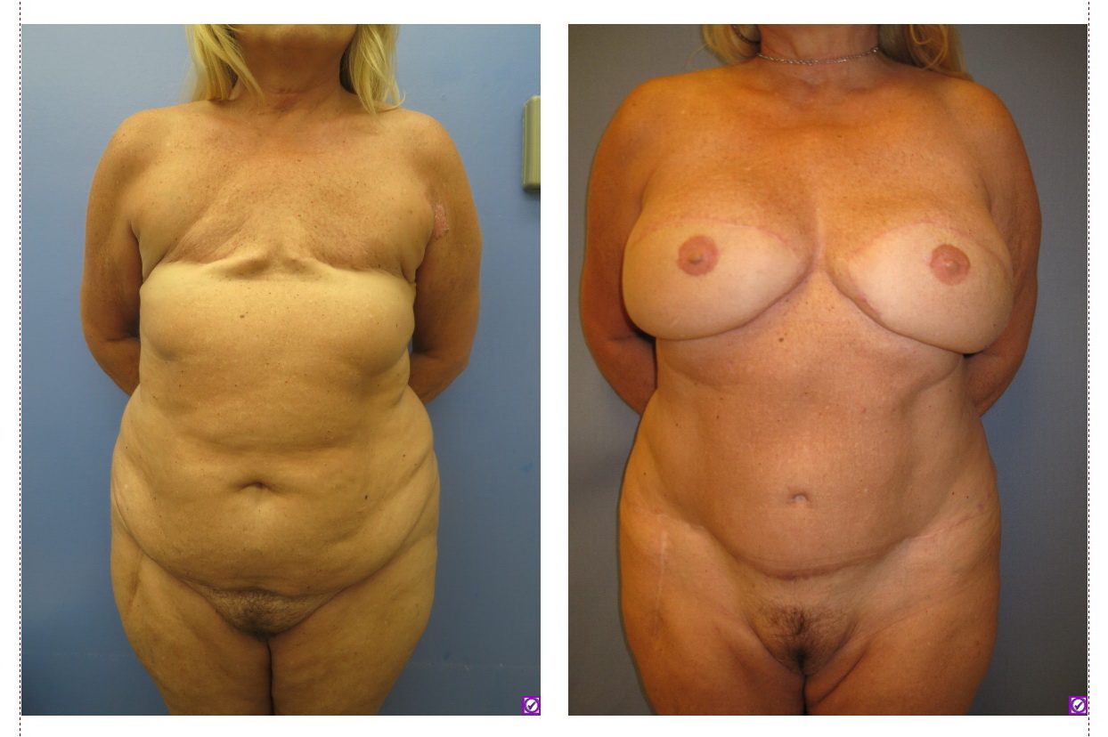 Before and after DIEP flap breast reconstruction