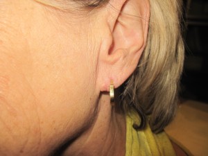 lobule torn earlobe repair