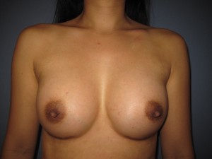 A breast augmentation result at rest