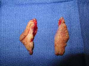 labiaplasty excision specimen