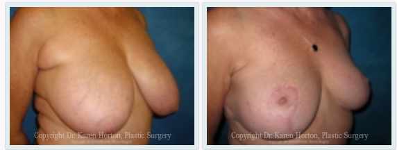 breast lift before and after karen horton md
