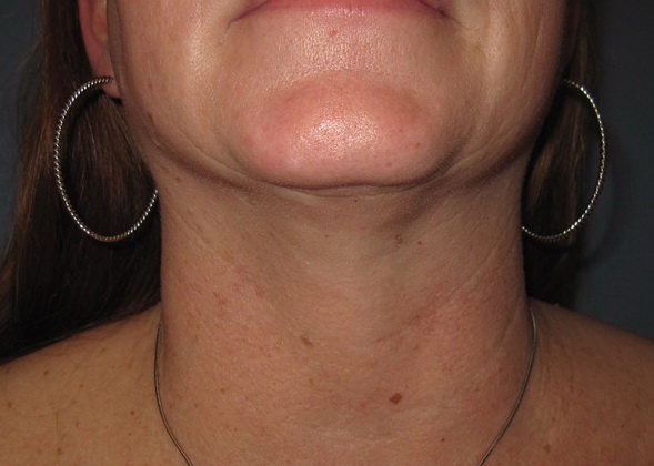 after neck lipo front