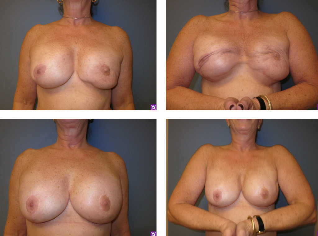 before after pec muscle replacement to chest wall