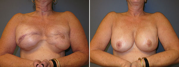 Breast Revision Surgery