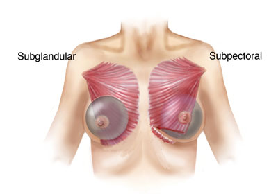 The benefits of subglandular implants for breast augmentation