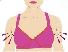 Liposuction of armpit fat (axillary rolls) – a VITAL complement to