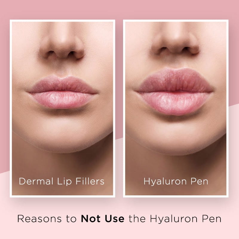 Schijn Behandeling Voorbeeld What You Should Know About the Hyaluron Pen