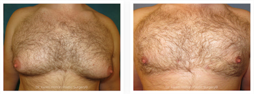 male breast surgery before and after pictures