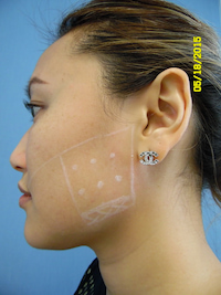 Markings showing the target area for Botox treatment on a real patient