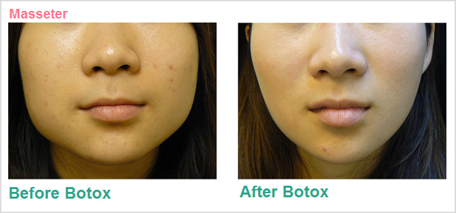Before and after photo of a patient who received botox to treat Bruxism