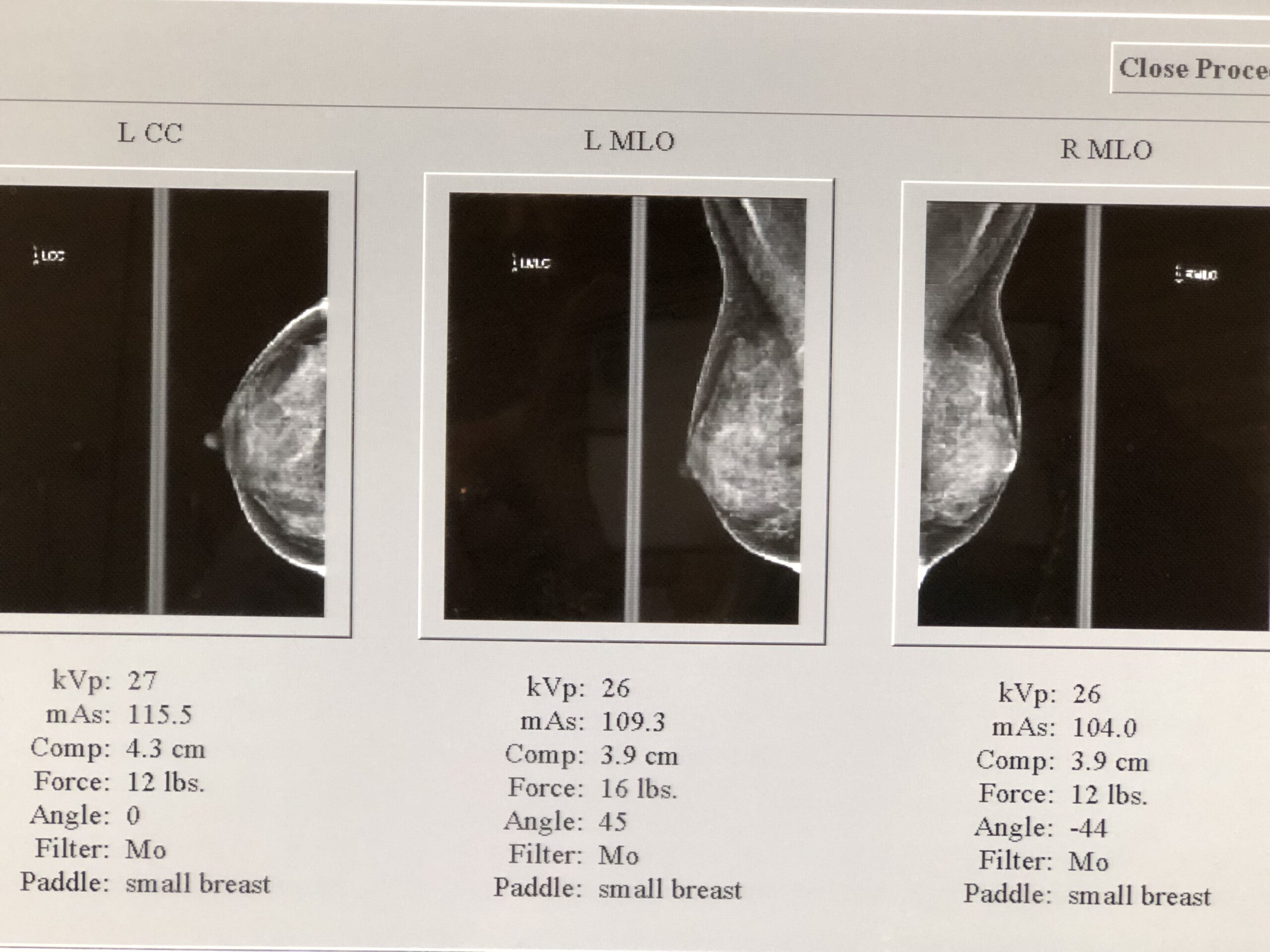 Mammograms with breast implants – Q & A with Dr. Horton